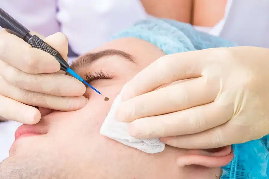 Unwanted Marks Options for Mole and Scar Removal