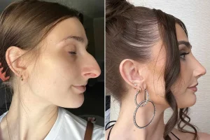 The Filtered Face: How Social Media is Shaping Rhinoplasty Decisions
