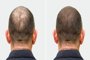 The George Costanza Toupee Moment and Modern Hair Replacement