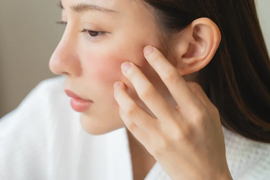 Rosacea Skincare