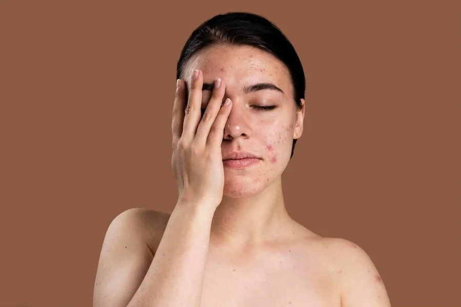 Fungal Acne