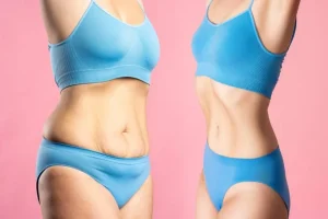 How Does Liposuction in Riyadh Enhance Body Contours Naturally?