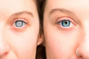Eye Doctor in Kansas City for Cataracts: What to Expect From Diagnosis to Surgery?