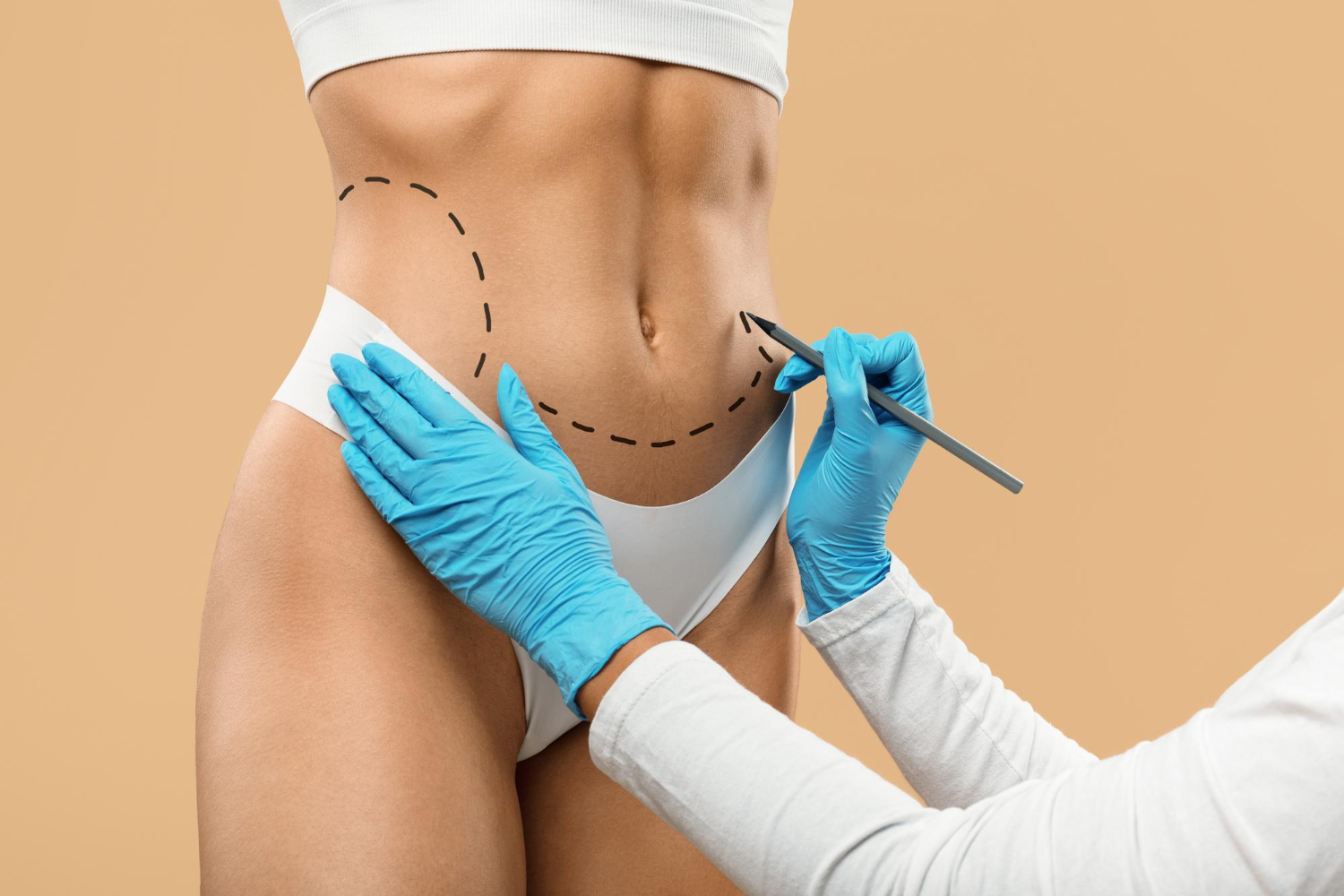 Liposculpture