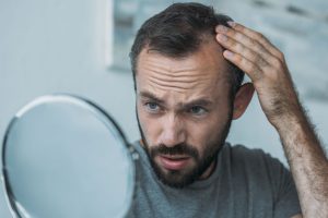 Early Signs of Male Pattern Baldness and 5 ways to fight it