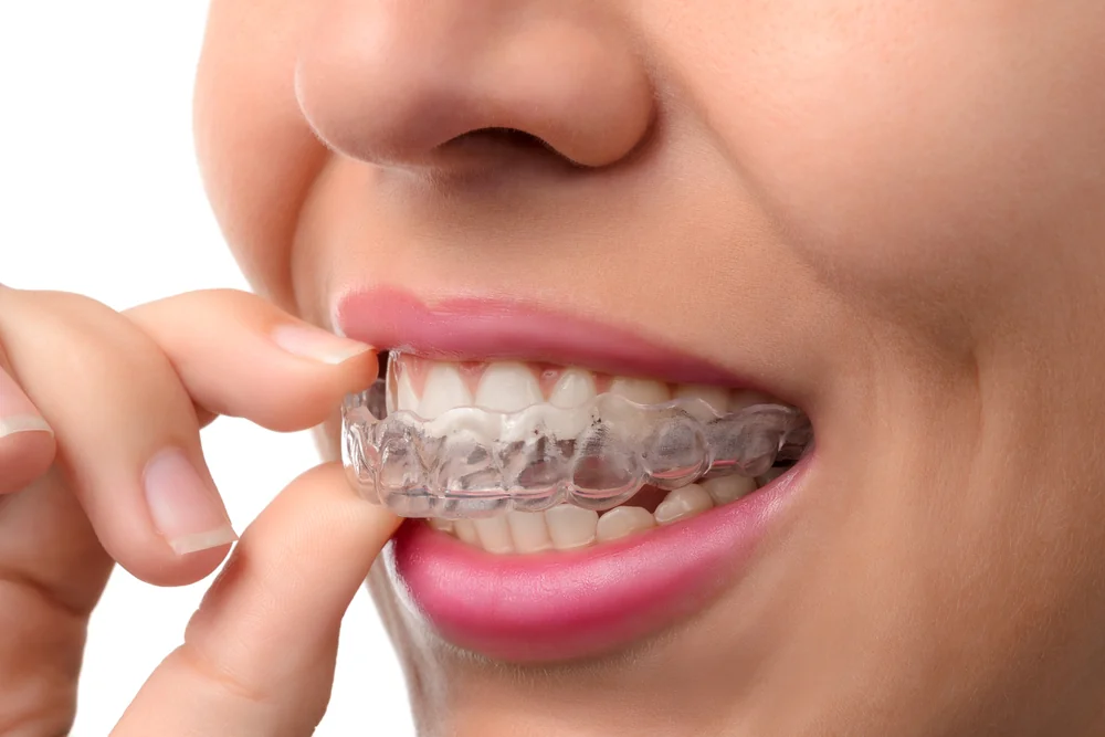 Clear Aligner