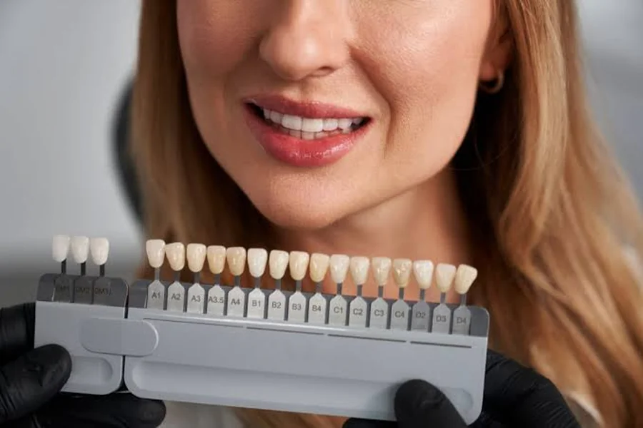Veneers