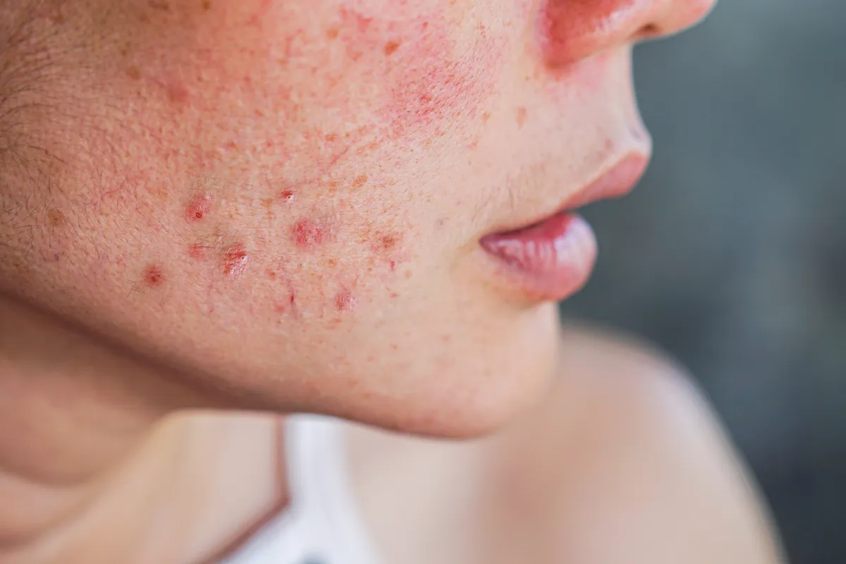 Acne Gel